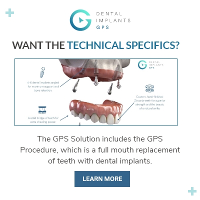 Dental Implants GPS